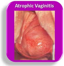 What is the Most Common Symptoms of Vaginal Atrophy?